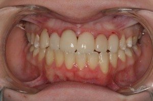 Restorative Dentistry After