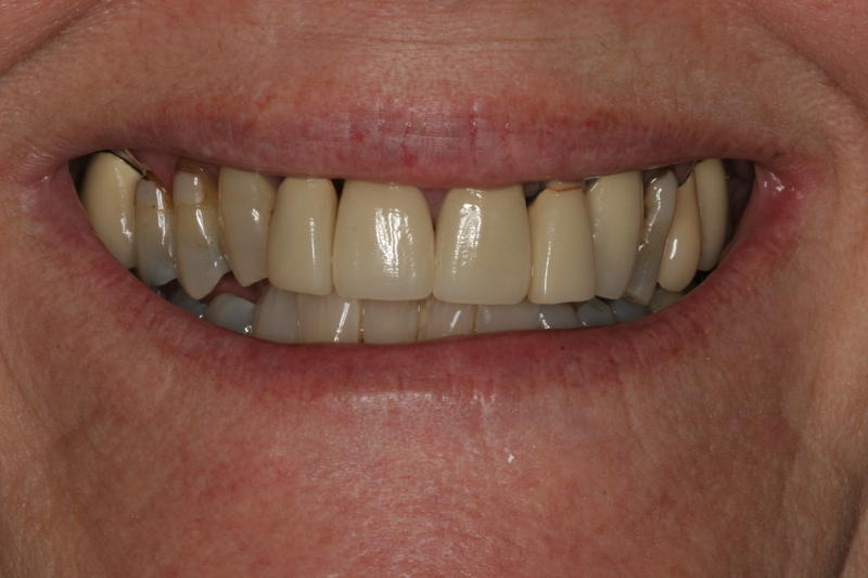 Cosmetic Dentistry Patient Before