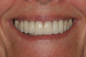 Cosmetic Dentistry Patient After