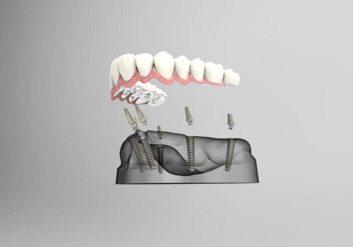 Implant-secured dentures in Columbus Georgia