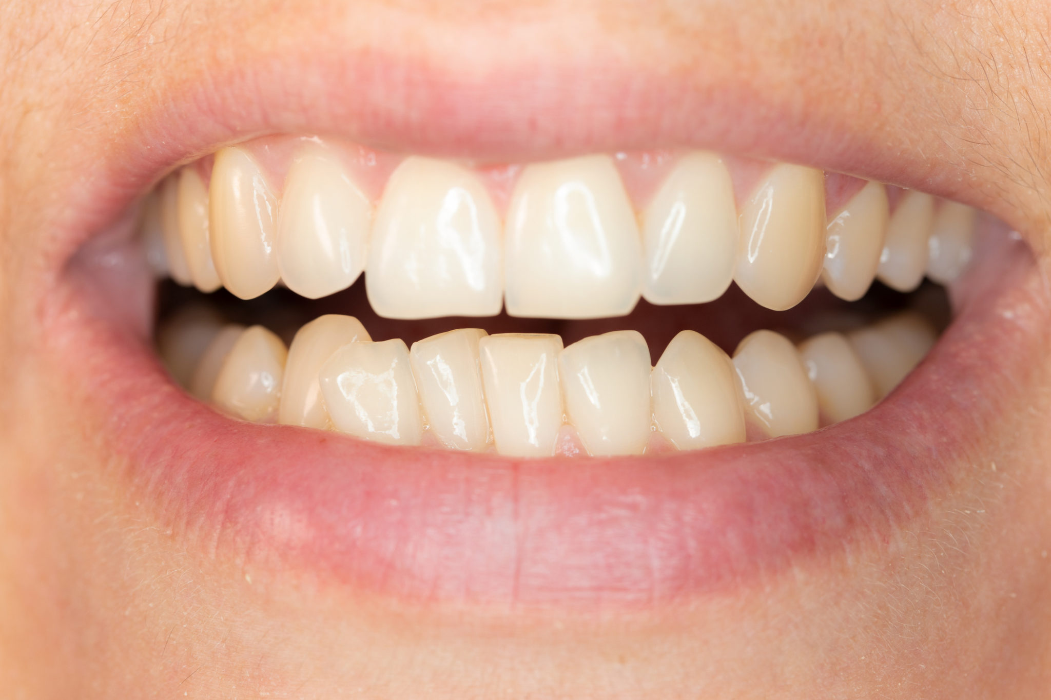 How Can I Straighten Misaligned Teeth? Columbus GA Dentist