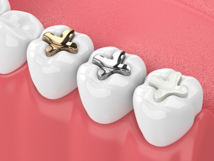 White Dental Fillings in Columbus, Georgia