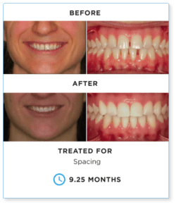 suresmile before and after