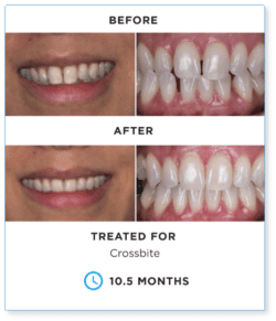 clear aligners before and after
