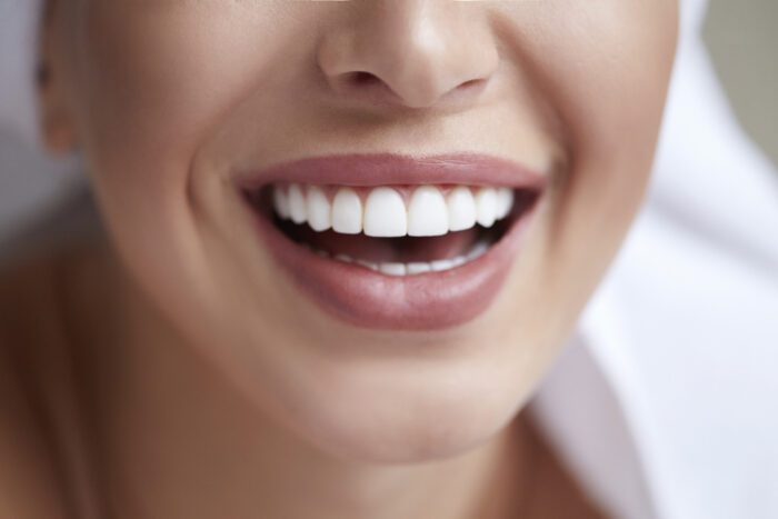 How Veneers Can Makeover Your Smile
