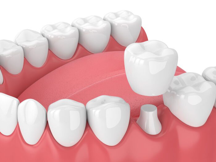 a dental crown in columbus, ga, can help preserve your natural tooth