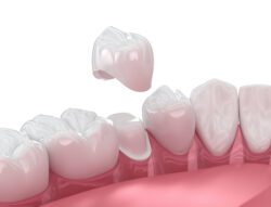Same Day Crowns: No Temporary, No Waiting in Columbus, GA