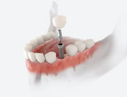 Dental Implants: What Our Team Wants You to Know in Columbus, GA